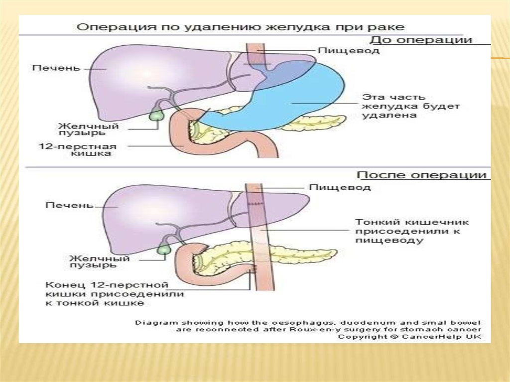 Схема flot при раке желудка