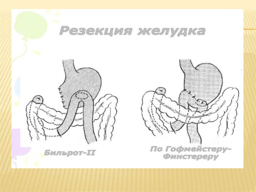 Схема flot при раке желудка