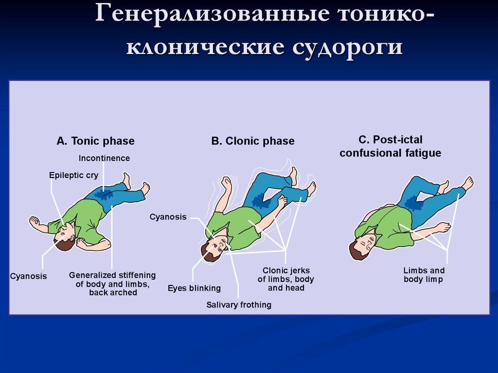 Подборка судорожные. Тонико-клонические и клонико-тонические судороги. Генерализованные тонико-клонические судороги - признак. Клонические и тонические судороги разница. Эпилепсия клонические судороги.