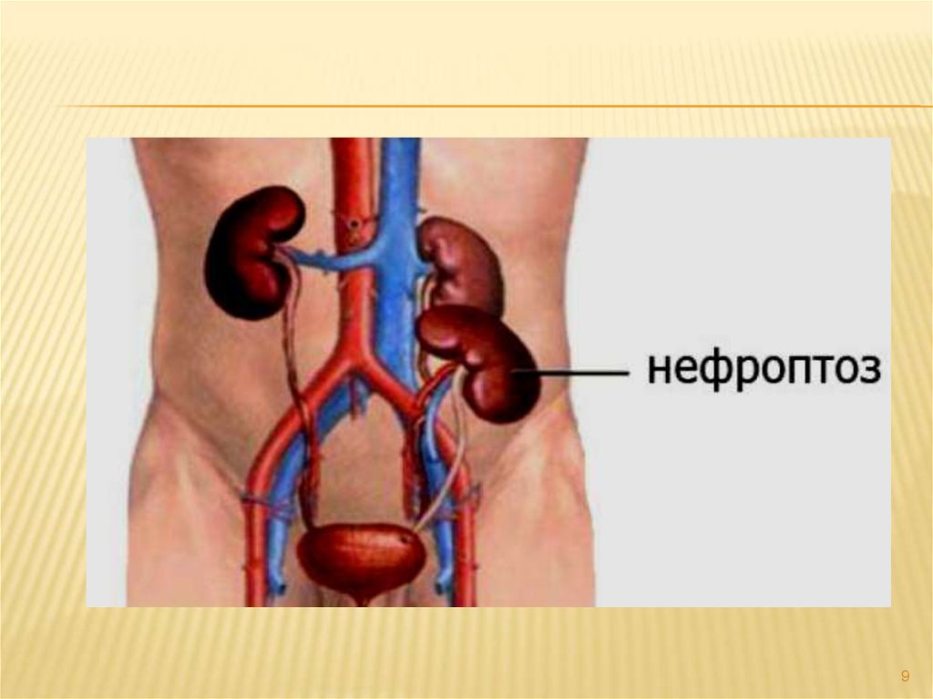 Нефроптоз это. Нефроптоз почек 3 степени. Правосторонний нефроптоз почки 1 степени. Нефроптоз 1 степени справа.