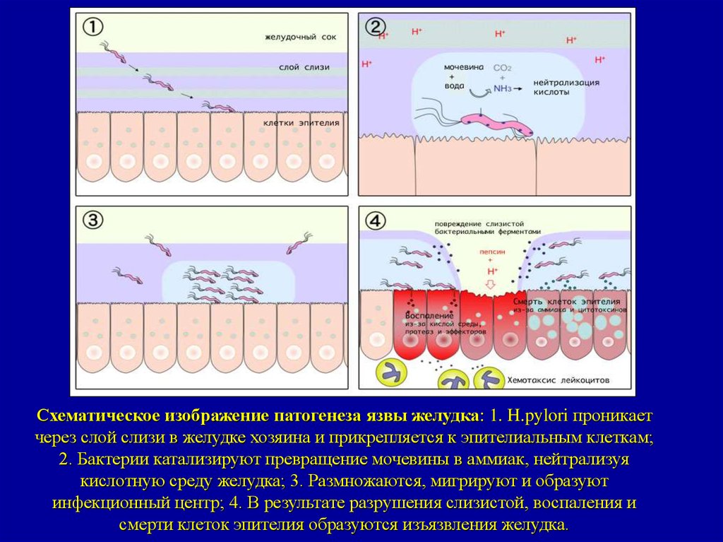 Язвенная болезнь желудка патофизиология презентация