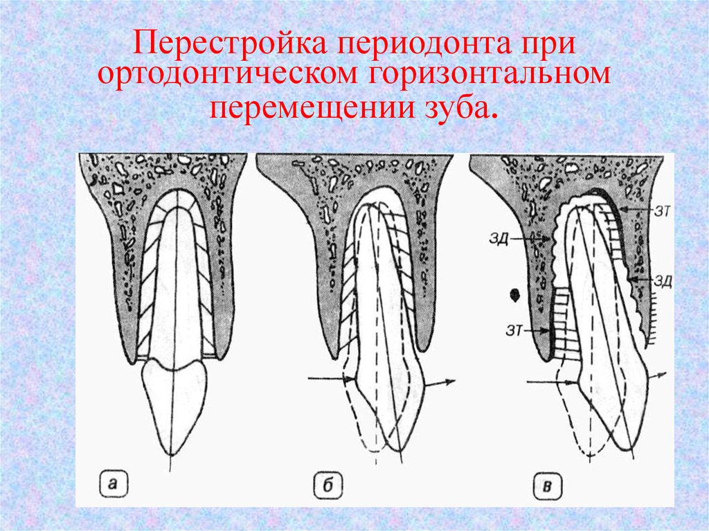 Переместилось корень. Микроскопическое строение периодонта. Перестройка периодонта. Изменения в тканях периодонта. Типы ортодонтического перемещения зубов.