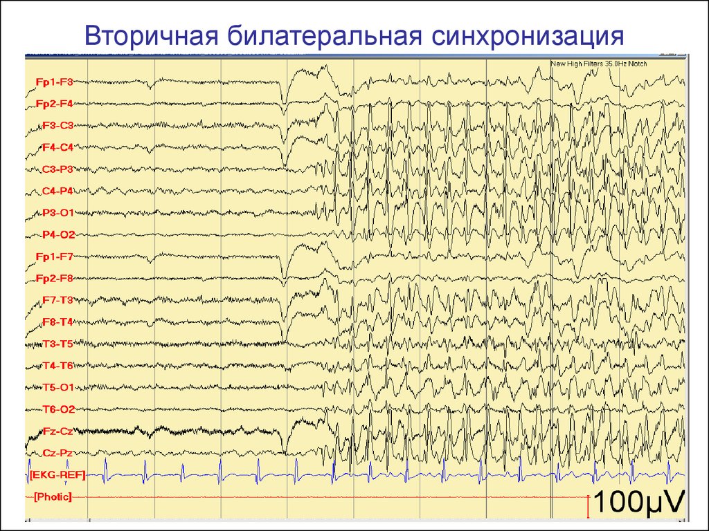 Эпи ээг. Синхронизация ЭЭГ. Вторичная билатеральная синхронизация. Синхронизированная активность ЭЭГ. Синхронизация ритма ЭЭГ.