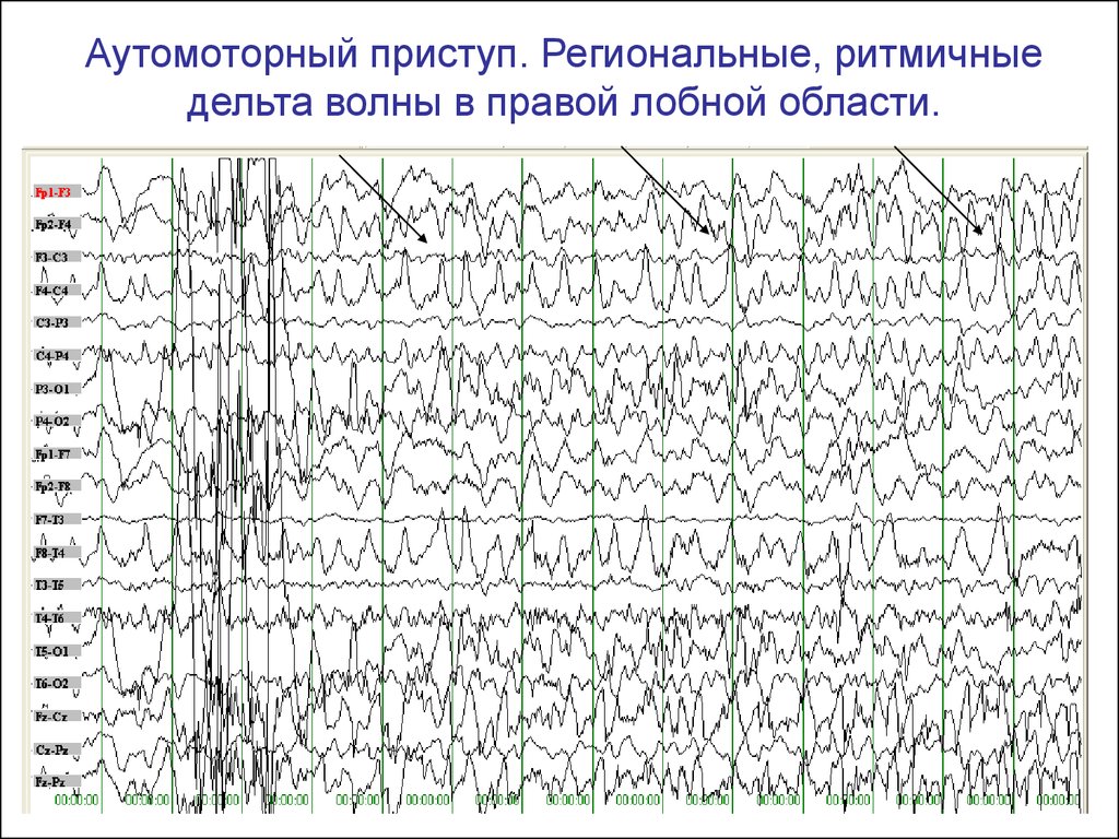 Ээг показывает эпилепсию. ЭЭГ при эпилептическом припадке. Вспышки Дельта волн на ЭЭГ. ЭЭГ больного эпилепсией. Эпилептический приступ на ЭЭГ.