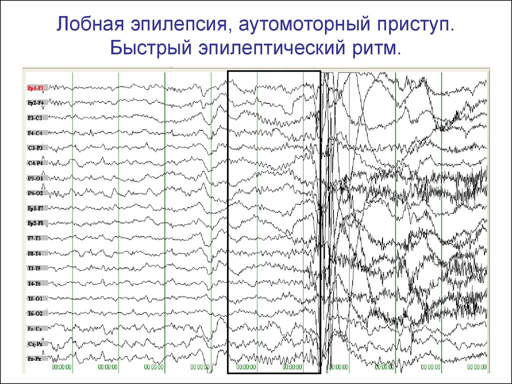 Лобная эпилепсия. ЭЭГ головного мозга эпилептиформная. ЭЭГ энцефалограмма эпилепсия. ЭЭГ больного эпилепсией. ЭЭГ здорового человека и эпилептика.