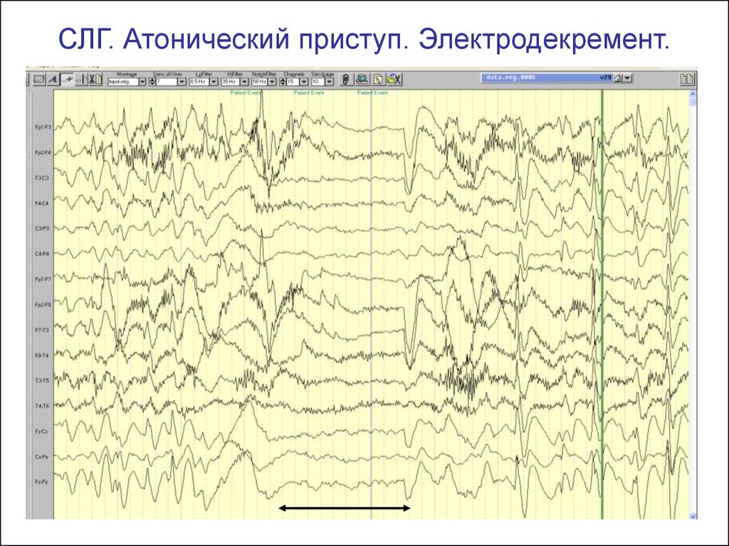 Ээг при эпилепсии. Эпилептический приступ на ЭЭГ. Миоклонический приступ на ЭЭГ. Приступ эпилепсии на ЭЭГ. ЭЭГ при эпилептическом припадке.