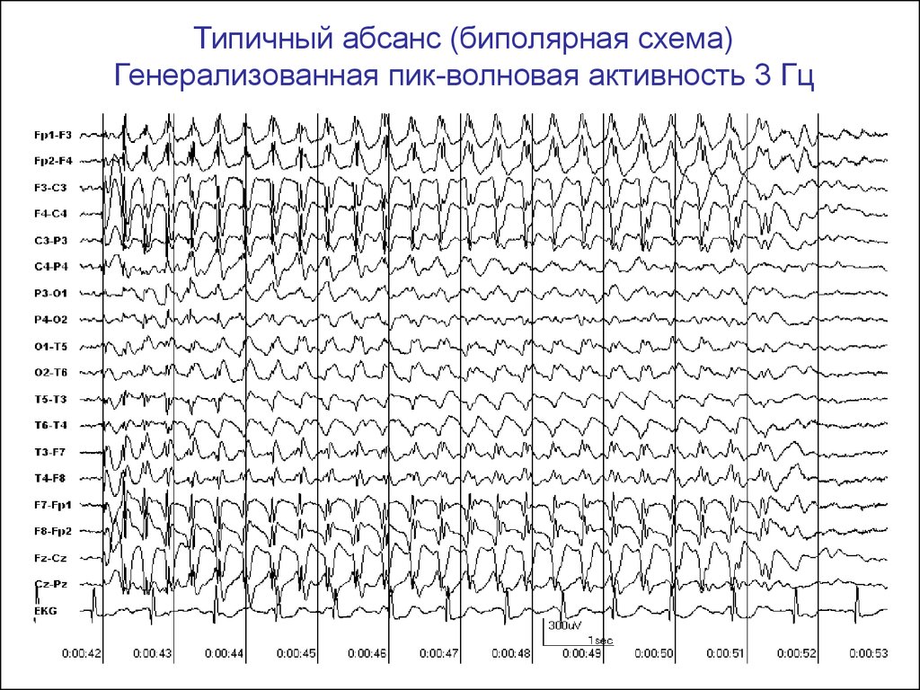 Ээг показывает эпилепсию. Абсансная эпилепсия на ЭЭГ. Паттерн абсанса на ЭЭГ. Генерализованная эпилептиформная активность на ЭЭГ У ребенка. Детская абсансная эпилепсия на ЭЭГ.