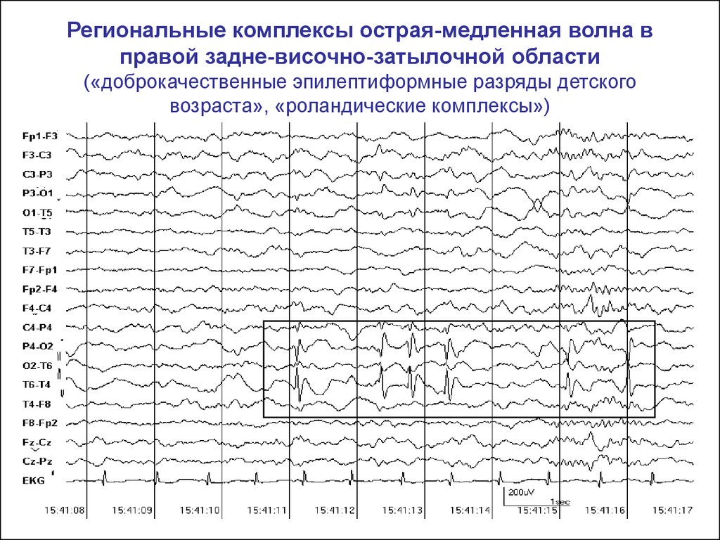 Ээг показывает эпилепсию. Роландическая эпилепсия ЭЭГ. Генерализованная эпилептиформная активность на ЭЭГ У ребенка. Доброкачественная роландическая эпилепсия на ЭЭГ. ЭЭГ волны при эпилепсии.