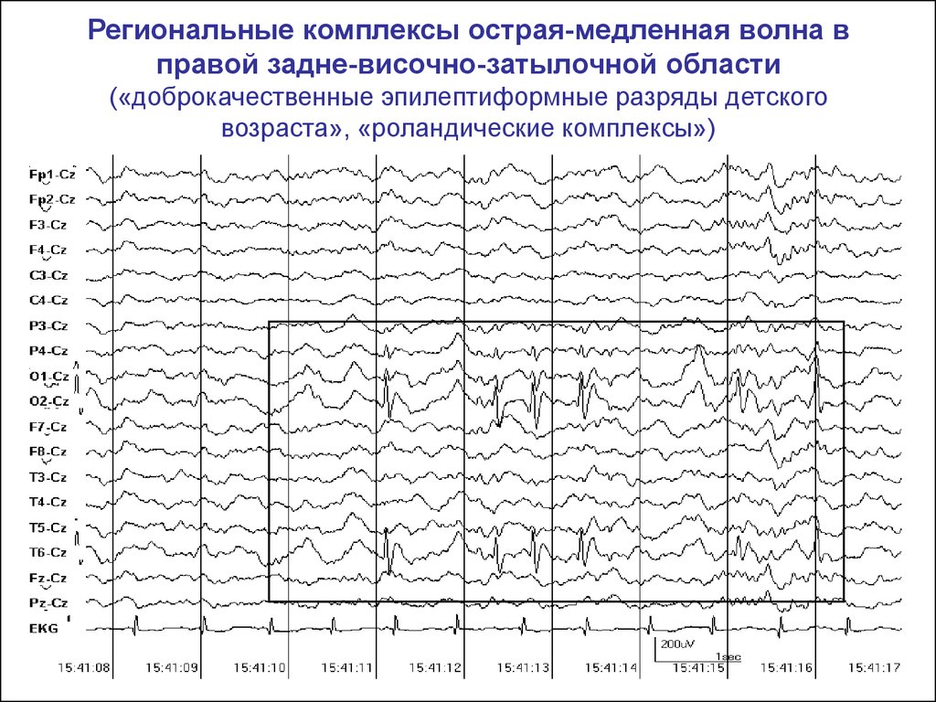 Спайки на ээг. Эпилептиформные паттерны на ЭЭГ. Медленная активность на ЭЭГ. Волны на ЭЭГ расшифровка. ЭЭГ паттерны при эпилепсии.