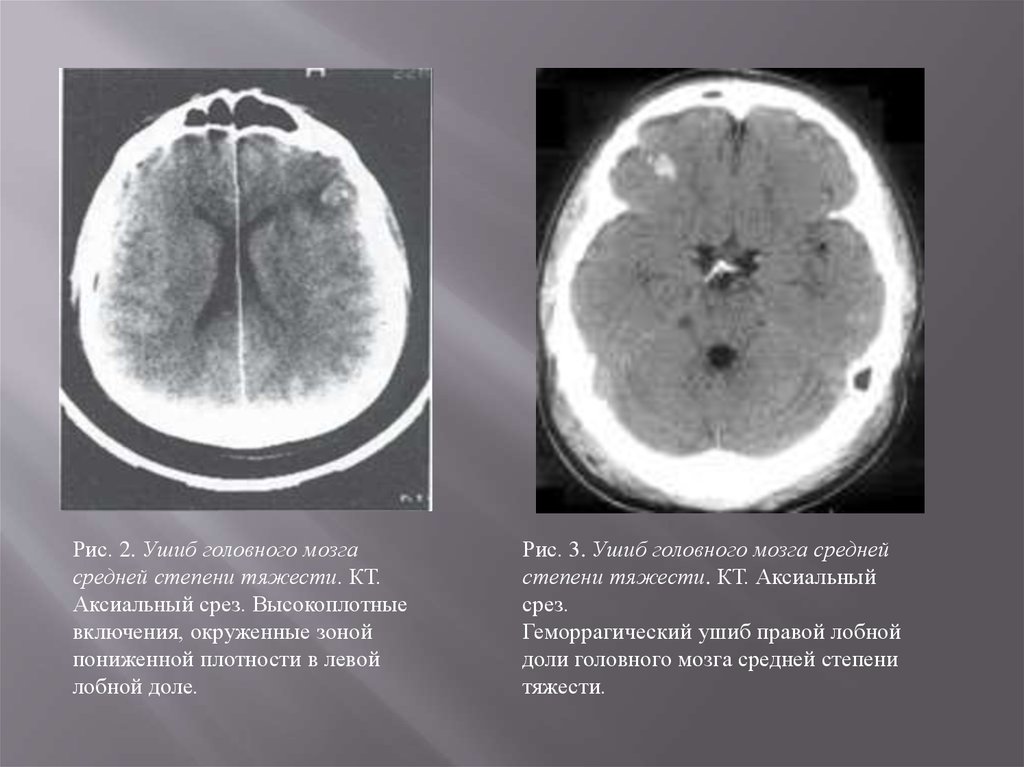 Кт при сотрясении головного мозга