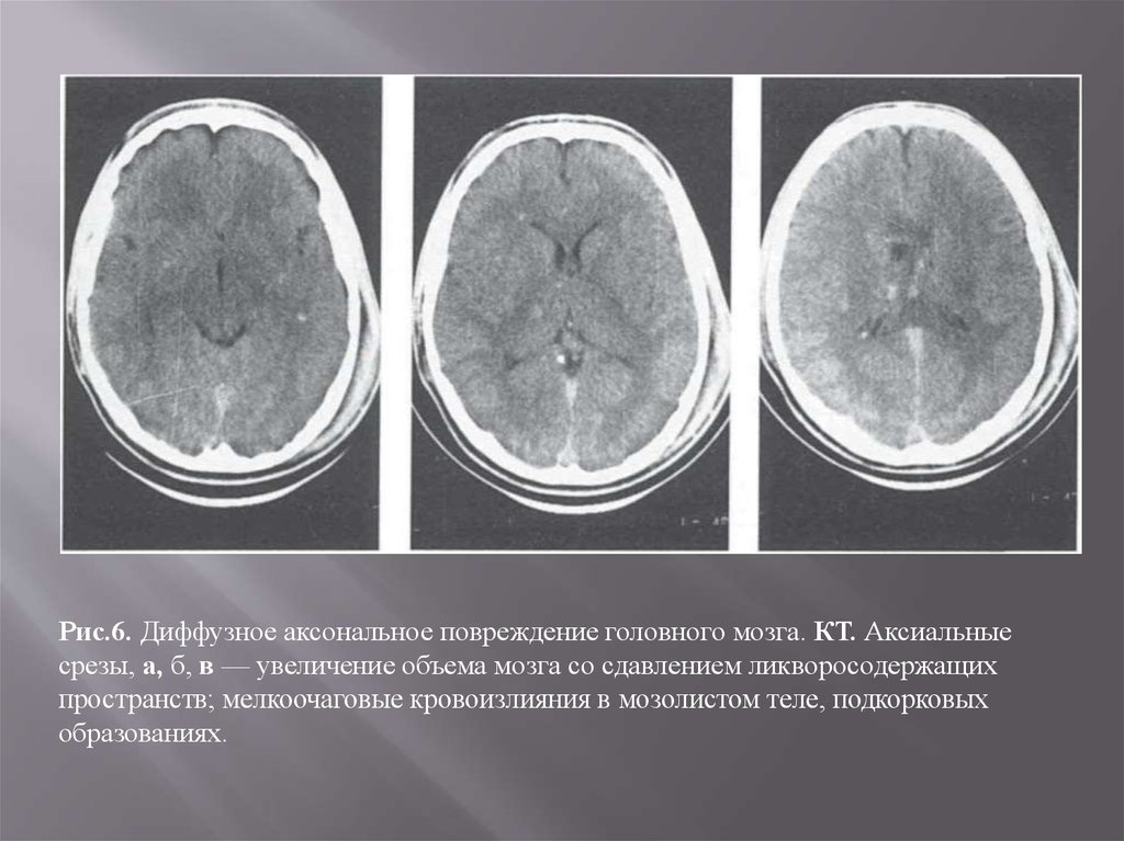 Сотрясение 4. Диффузное аксональное повреждение кт. Диффузное аксональное повреждение мозга кт. Микроангиопатия головного мозга на кт.