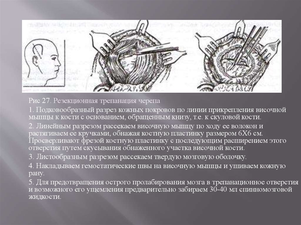 Трепанация. Костно-пластическая Трепанация черепа ход операции. Трепанация черепа головного мозга. Костно-пластическая Трепанация черепа осложнения. Трепанация черепа инструменты для операции ход операции.