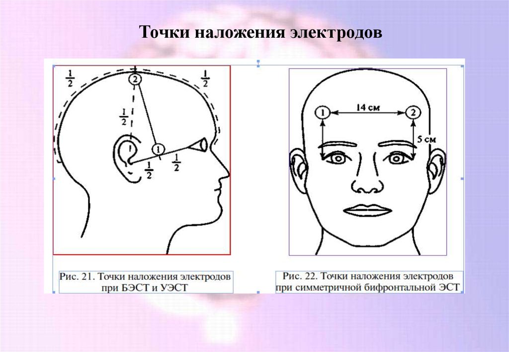 Схема 10 20 наложение электродов