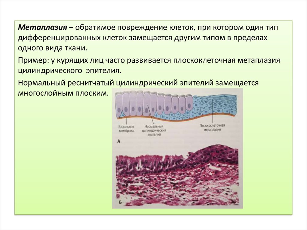 Метаплазия это. Метаплазия эпителиальной ткани. Метаплазия эпителия бронхов. Метаплазия мерцательного эпителия бронхов.