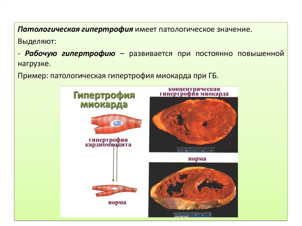 Гипертрофия миокарда. Патологическая гипертрофия миокарда. Физиологическая гипертрофия. Гипертрофия понятие. Рабочая патологическая гипертрофия.