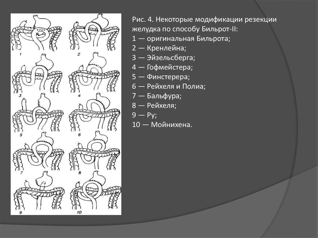 Резекция желудка по бальфуру схема