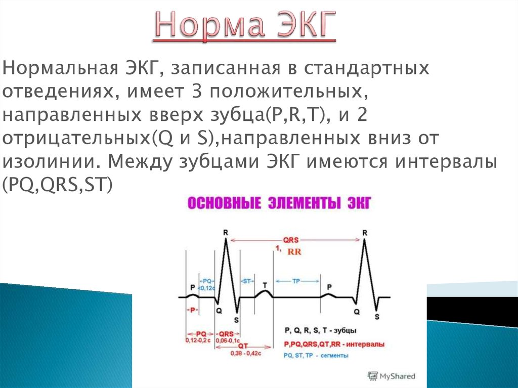 Рисунок экг в норме