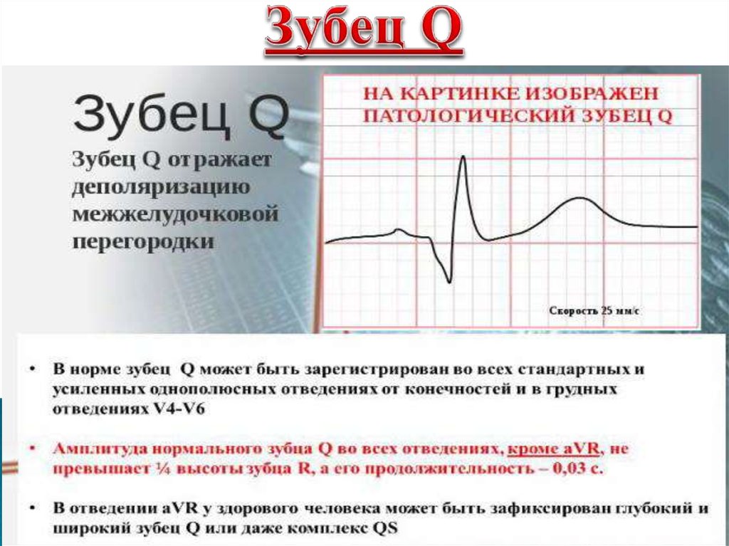 Изменение зубца q. Зубец q на ЭКГ AVL. ЭКГ глубокий отрицательный зубец q. Глубокий зубец q на ЭКГ v4. Зубец q II III AVF.