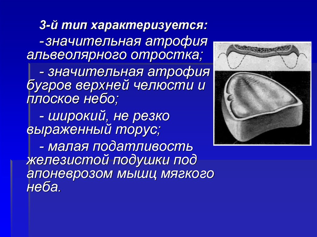 Резко выраженный. Атрофия альвеолярного отростка. Степени атрофии альвеолярного отростка. Значительная атрофия альвеолярного отростка. Атрофия альвеолярных отростков и плоское небо.