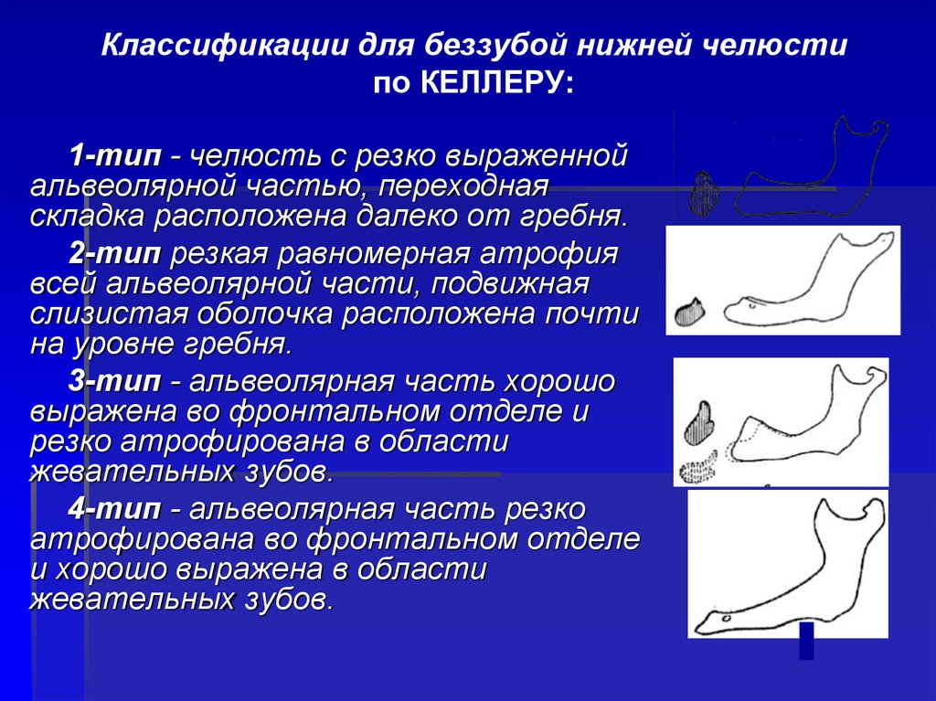 Классификация челюстей по шредеру. Атрофия альвеолярного отростка по Келлеру. Классификация Келлера беззубых челюстей. Классификация атрофии беззубых челюстей Шредера. Классификация беззубых челюстей по Оксману Шредеру Келлеру.