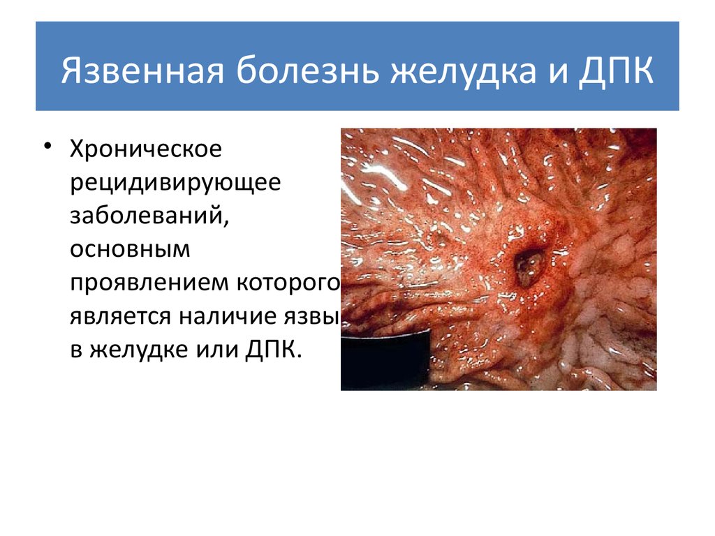 Реферат: Рентгенодиагностика язвенной болезни