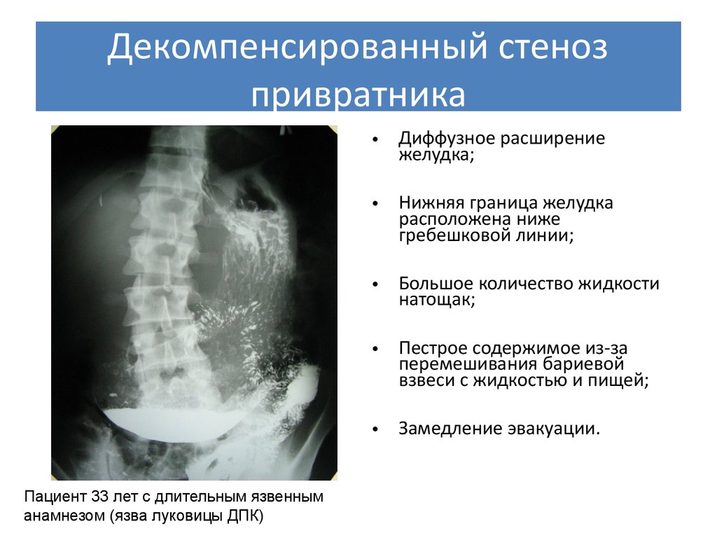 Осложнения стеноза. Степени стеноза привратника рентген. Стадии стеноза привратника рентген. Рубцовый стеноз привратника осложнения. Рентген при стенозе привратника.