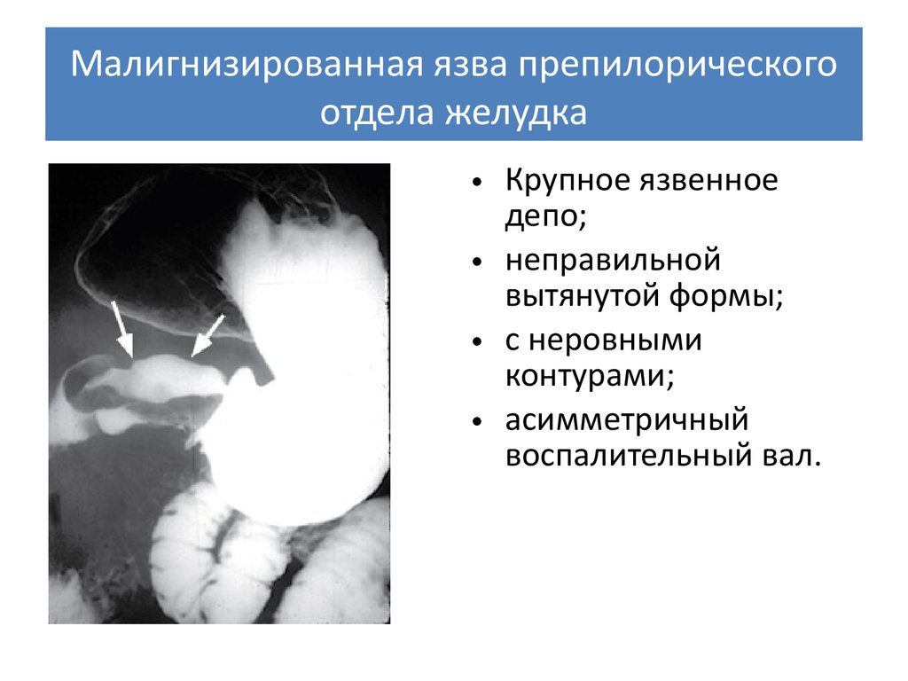 Клиническая картина язвы