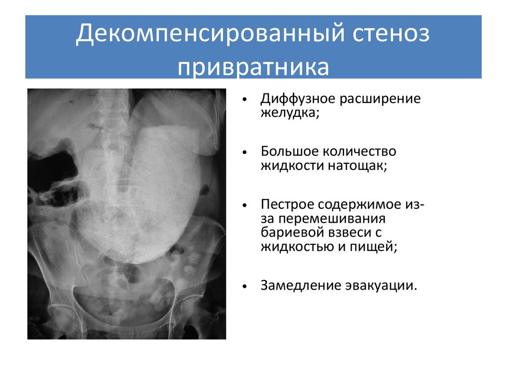 Осложнения стеноза. Характерный симптом декомпенсированного стеноза привратника. Стеноз выходного отдела желудка рентген. Стеноз привратника рентгенограмма. Субкомпенсированный стеноз желудка рентген.