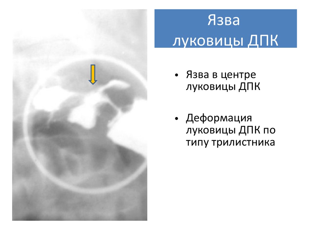 Язва луковицы дпк