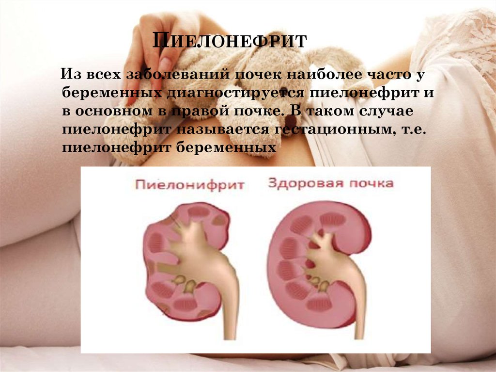 Почечная инфекция. Пиелонефрит и беременность. Гестационный пиелонефрит. Uестационный пиелонефрит.