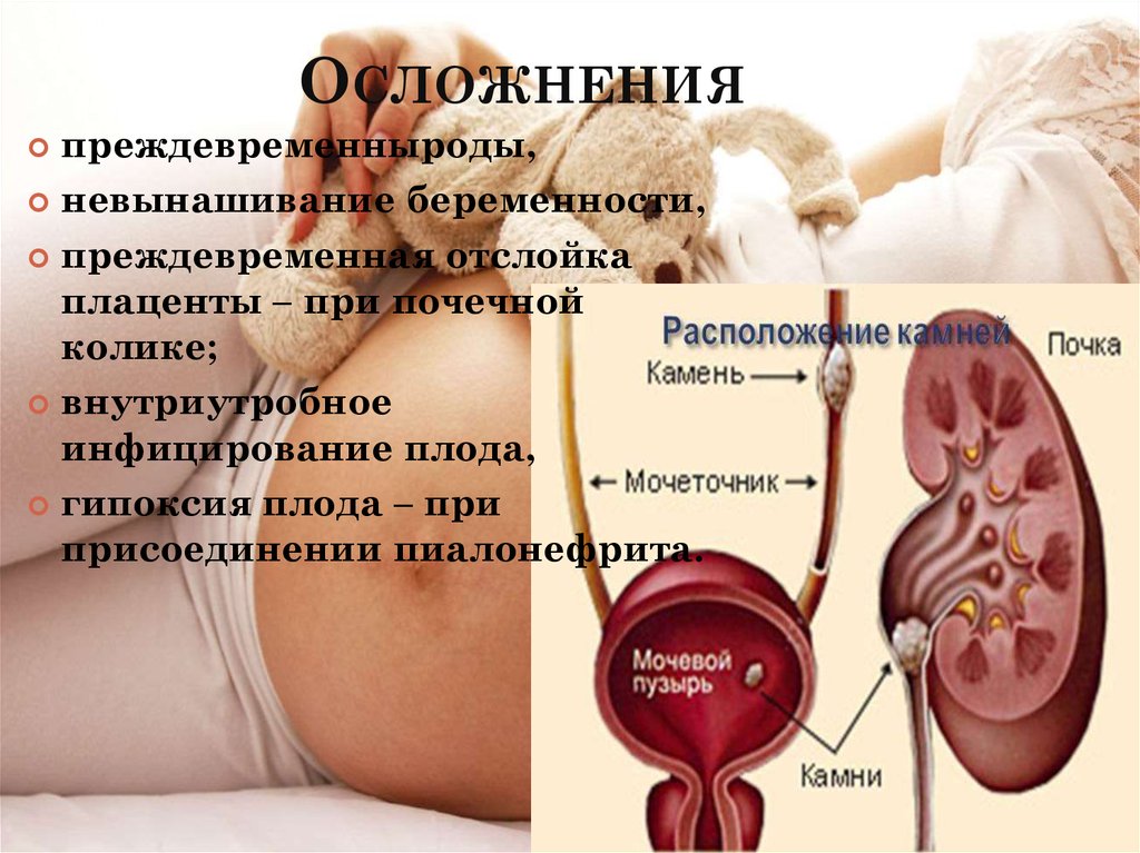 Пиелонефрит картинки для презентации