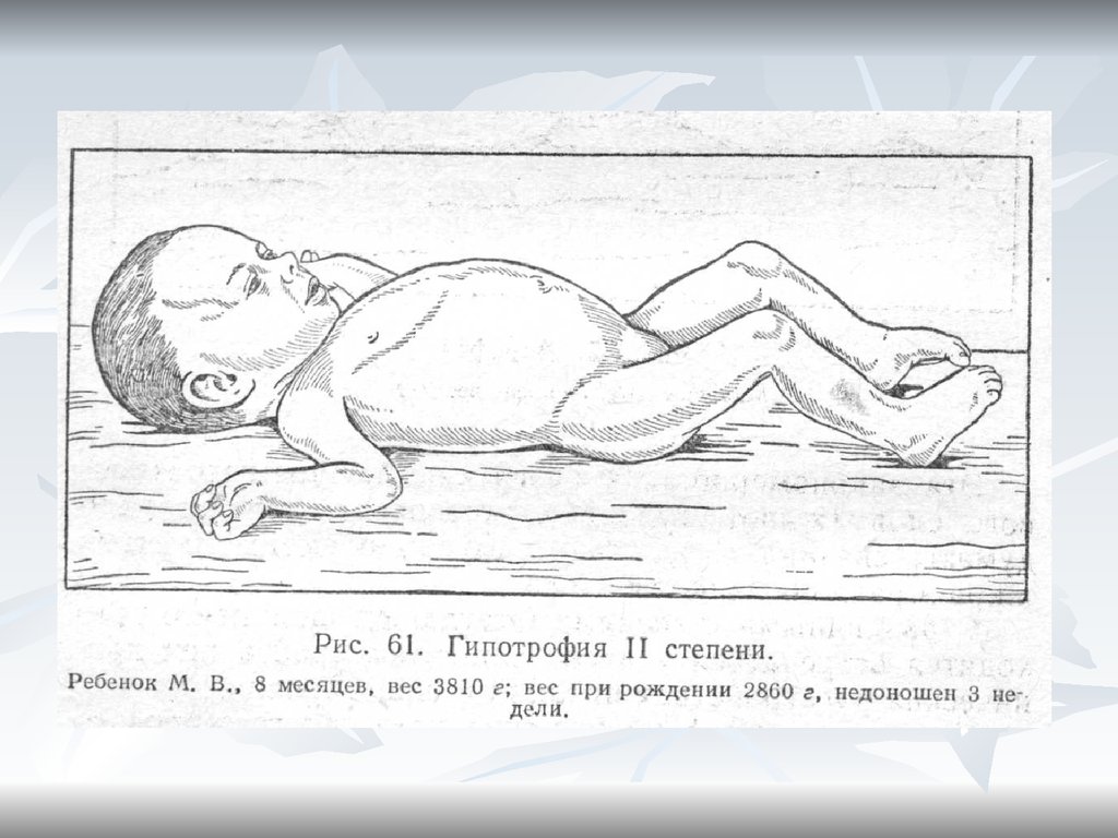 Дети 2 степени. Гипотрофия 2 степени у детей. Гипотрофия 2 степени у новорожденных. Гипотрофия (1,2,3 степени). Гипотрофия первой степени новорожденных. Гипотрофия 1 степени у новорожденного.