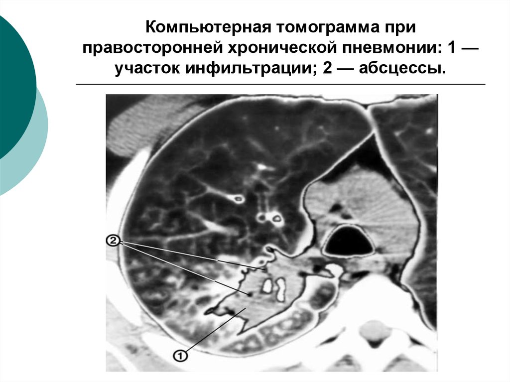 Хроническая пневмония. Хроническая эозинофильная пневмония кт. Хроническая пневмония кт. Блокированный абсцесс кт.