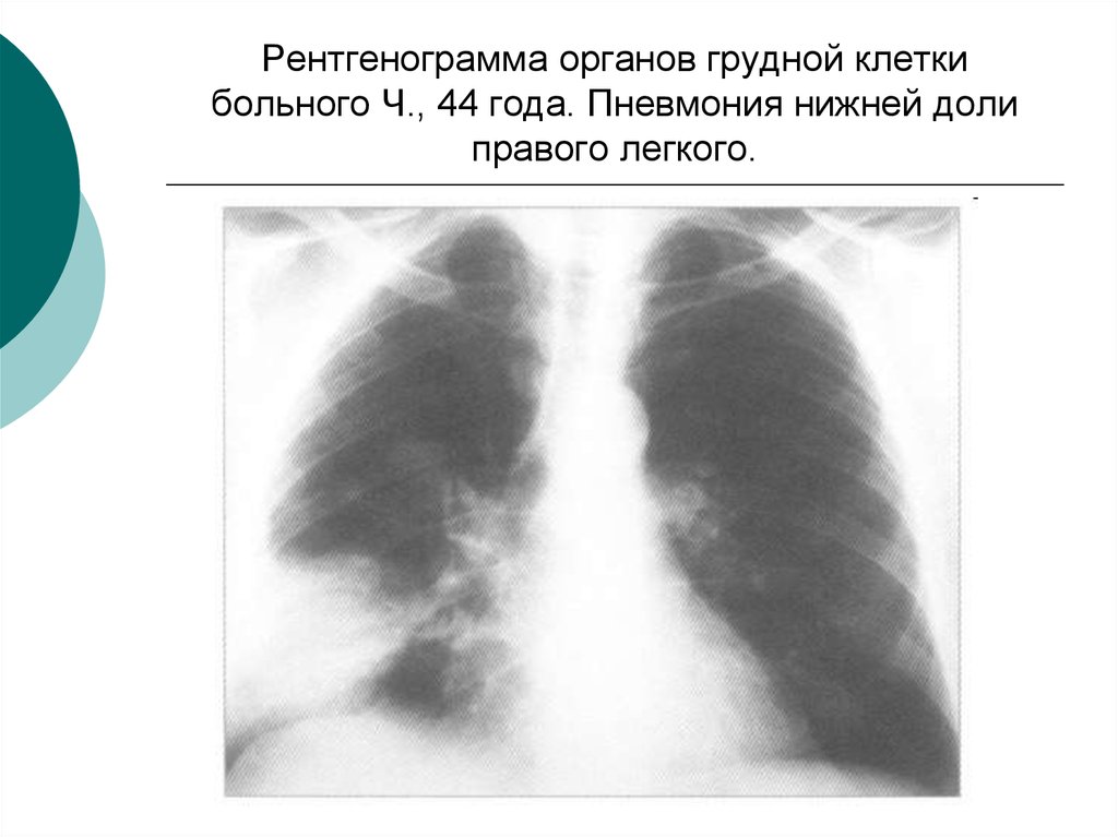 Пневмония верхней доли легкого. Полисегментарная пневмония снимки. Крупозная пневмония рентген. Рентгенография грудной клетки пневмония. Рентген органов грудной клетки пневмония.