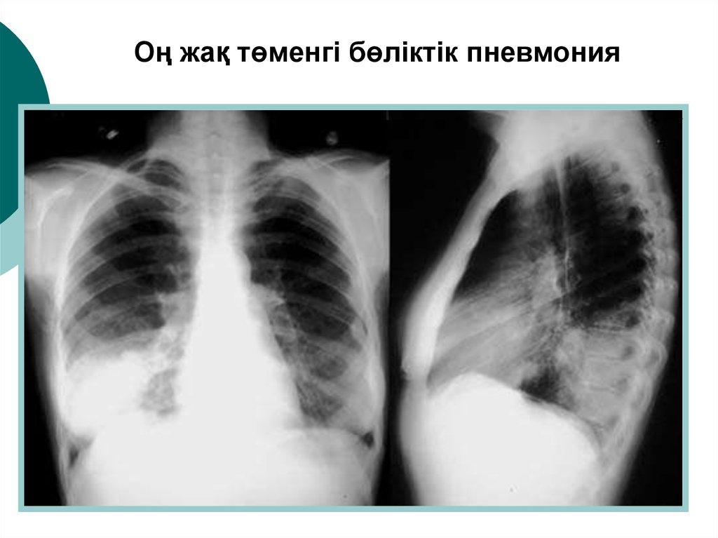 Пневмония на рентгене. Нижнедолевая пневмония рентген. Пневмония легкого рентгенограмма. Очаговая бронхопневмония рентген. Правосторонняя бронхопневмония рентген.