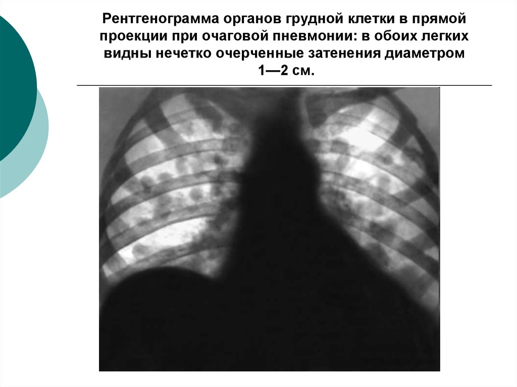 Клетка пневмонии