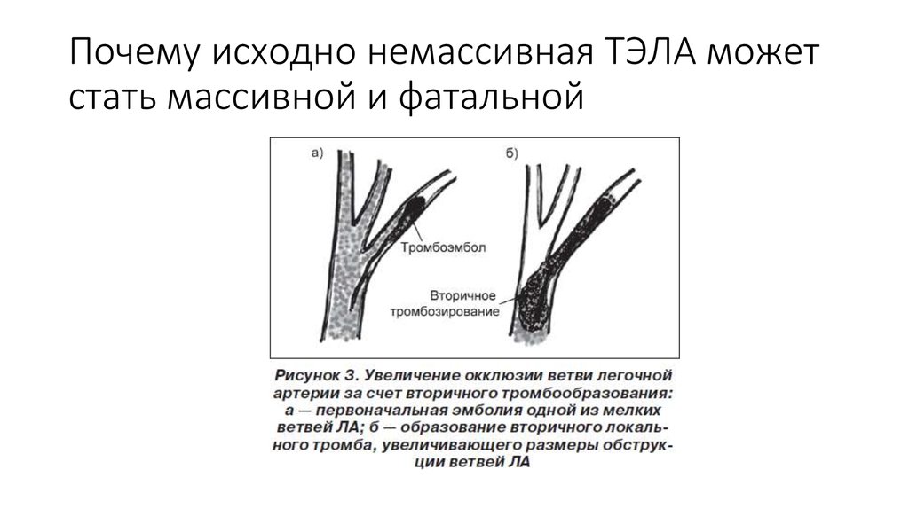 Почему первоначально. Немассивная Тэла. Тэла мелких ветвей. Тромбоэмболия мелких ветвей. Немассивная Тэла клиника.