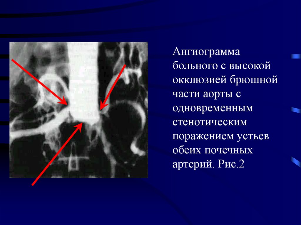 Увеличение легочной аорты