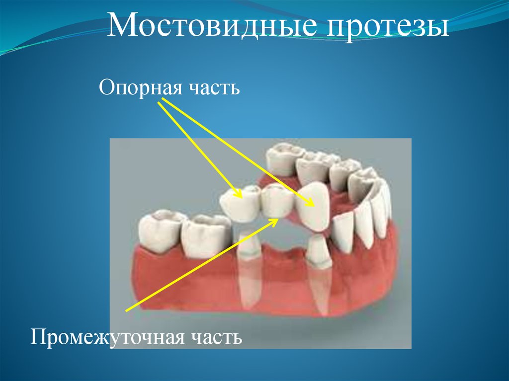 Виды зубных протезов фото