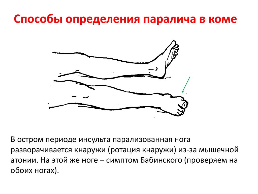 После инсульта парализована правая сторона. Патологические рефлексы симптом Бабинского. Положительный рефлекс Бабинского. Стопные знаки Бабинского. Патологический рефлекс Бабинского проявляется при поражении.