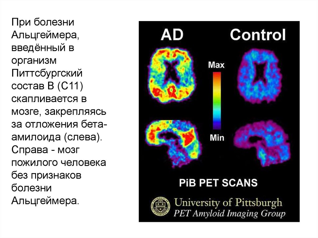 Тест против. ПЭТ мозга при Альцгеймера. Упражнения при болезни Альцгеймера. ПЭТ мозга при болезни Альцгеймера. Текст при болезни Альцгеймера.