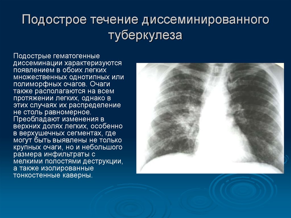 Очаговых изменений правого легкого. Подострый диссеминированный туберкулез рентген. Лимфогенно диссеминированный туберкулез рентген. Диссеминированный туберкулез легких рентген картина. Милиарный диссеминированный туберкулез рентген.