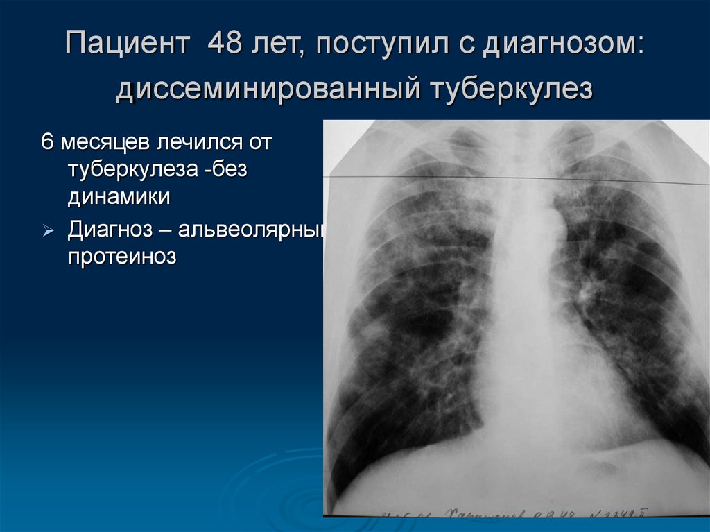 Туберкулез в спб. Диссеминированный туберкулез диагноз. Лечится ли туберкулез полностью.