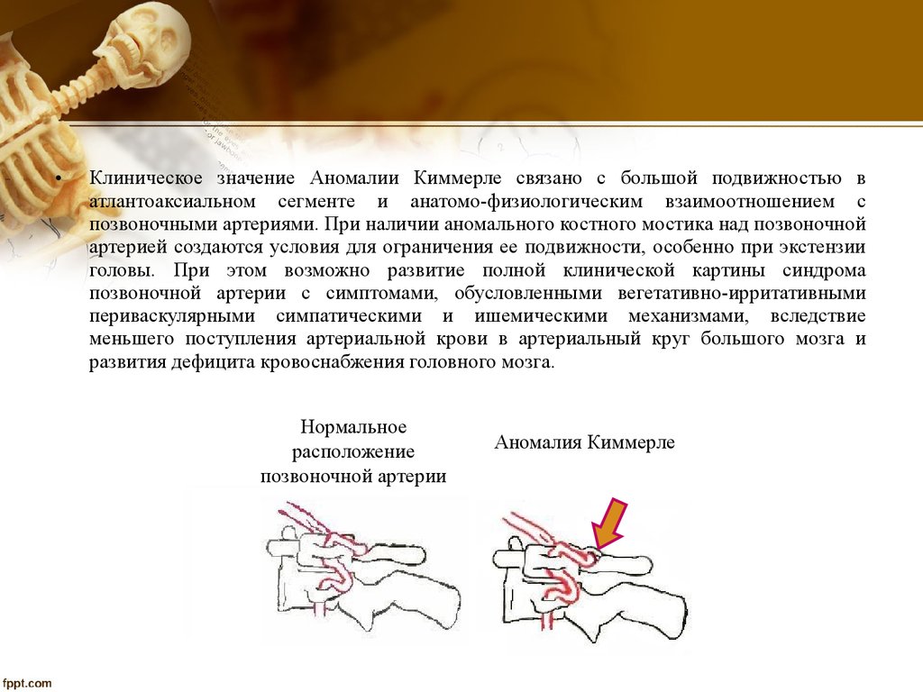 Неполная аномалия киммерли. Аномалия Киммерли полное костное кольцо. Аномалия Киммерли синдром позвоночной артерии. Неполная аномалия Киммерли с1. Аномалия Киммерли головные боли.