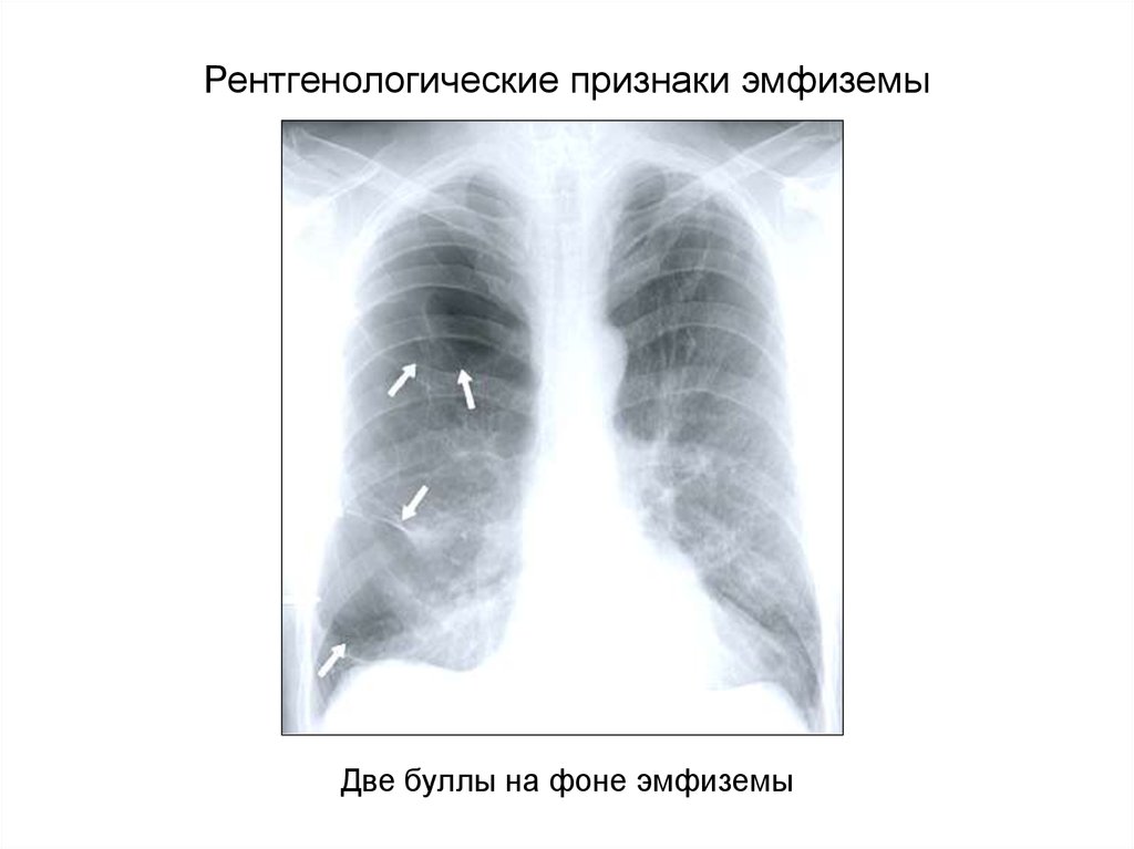 Рентгенологическая картина при хобл