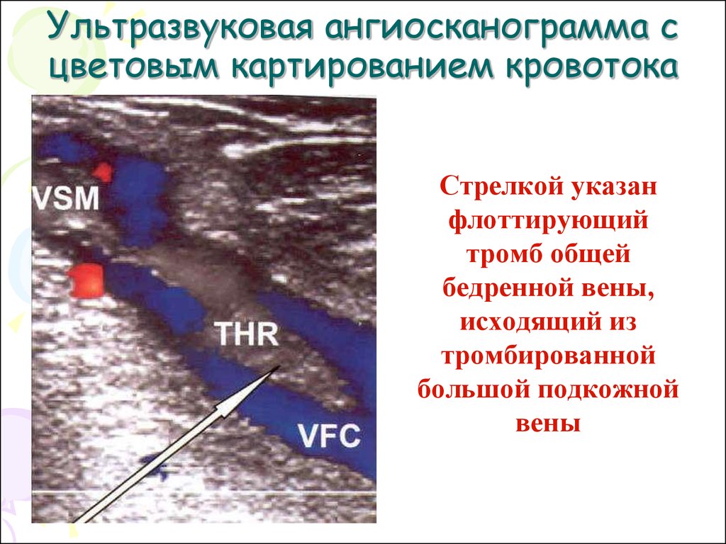 Тромб полой вены. Тромбоэмболия подкожных вен. Тромбоз поверхностной бедренной артерии на УЗИ. Флотирующий тромб в большой подкожной Вене.