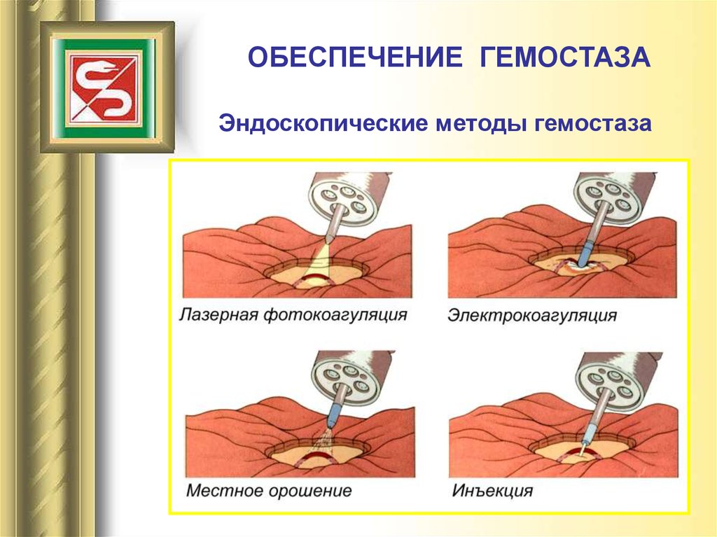 Кровотечение остановка кровотечения хирургия презентация