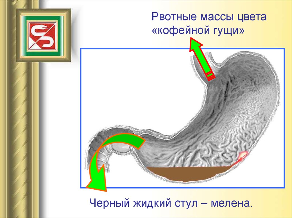 Стул мелена может наблюдаться при