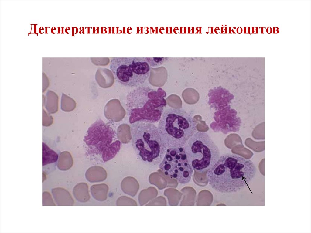 Изменения лейкоцитов в крови. Дегенеративные изменения лейкоцитов в крови. Пикнотичные ядра нейтрофилов. Дегенеративные изменения Лейко. Дегенеративные изменения ядра лейкоцитов.
