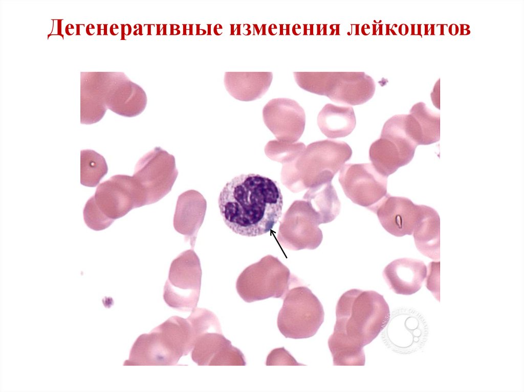 Изменения лейкоцитов в крови. Палочкоядерные нейтрофилы. Палочкоядерные нейтрофилы микроскоп. Юный нейтрофил под микроскопом. Тельца Князькова-деле в лейкоцитах это.